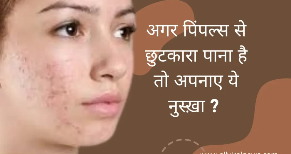 अगर पिंपल्स से छुटकारा पाना है तो अपनाए ये नुस्ख़ा ?